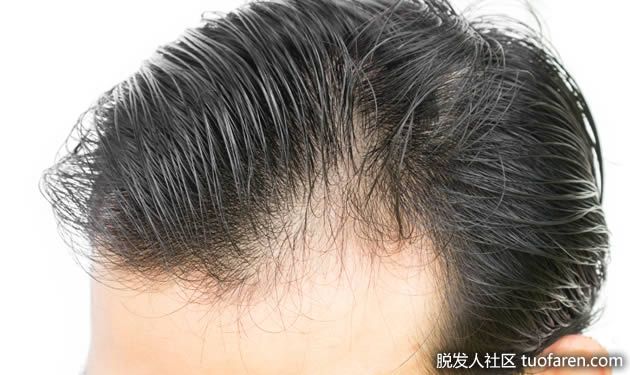 M型脱髮 M型脱髮