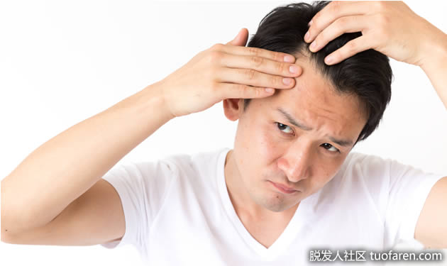 M型脱髮的初期症狀 M型脱髮的初期症狀