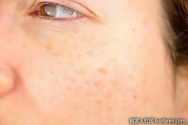 蘋果醋去除瑕疵 蘋果醋去除瑕疵