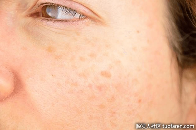 老人斑 老人斑