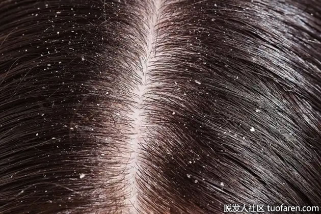 迷迭香對抗頭皮屑 迷迭香對抗頭皮屑