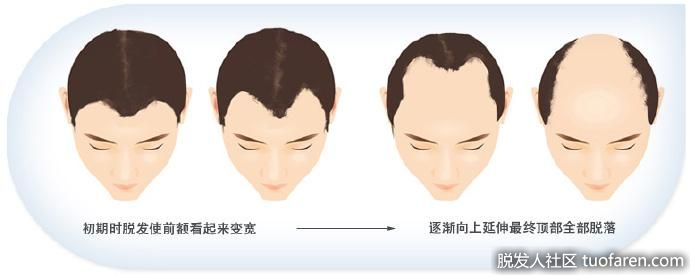 脱髮類型、脱髮等級對照圖3