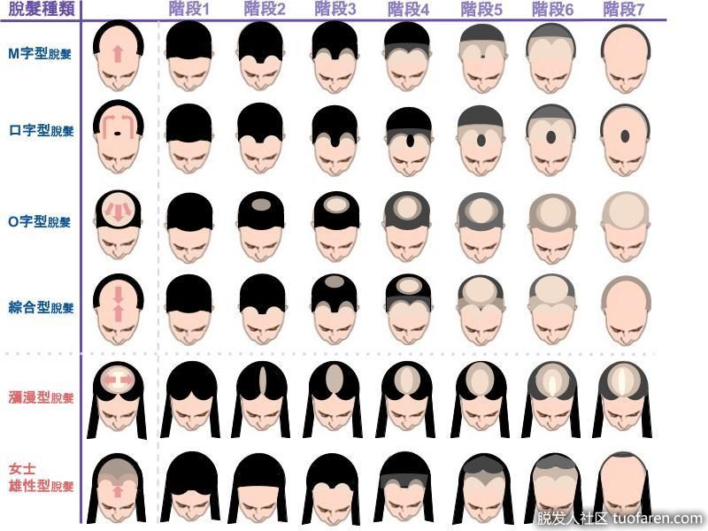 脱髮類型、脱髮等級對照圖2