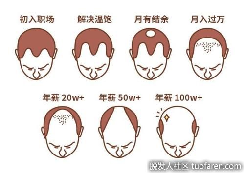 脱髮類型、脱髮等級對照圖4