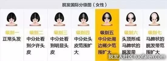 脱髮類型、脱髮等級對照圖5