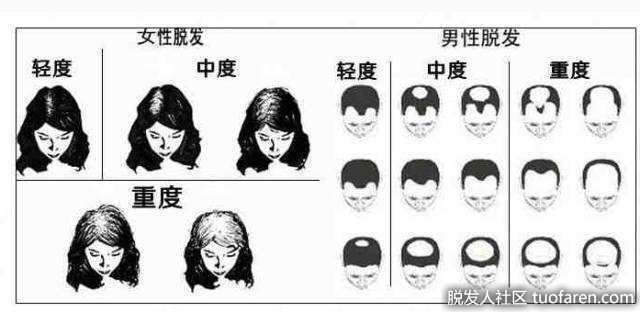 脱髮類型、脱髮等級對照圖6
