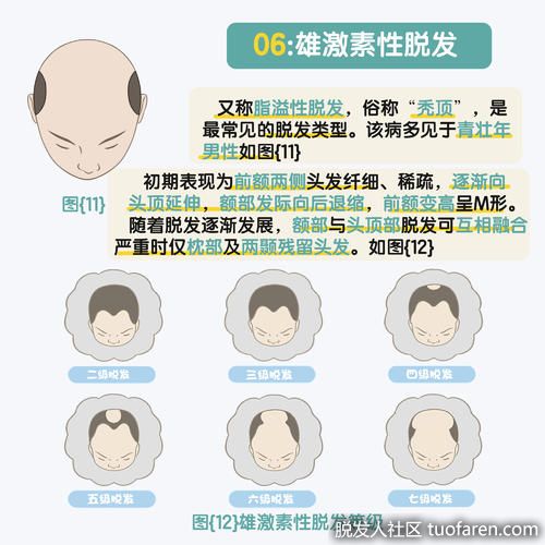脱髮類型、脱髮等級對照圖7