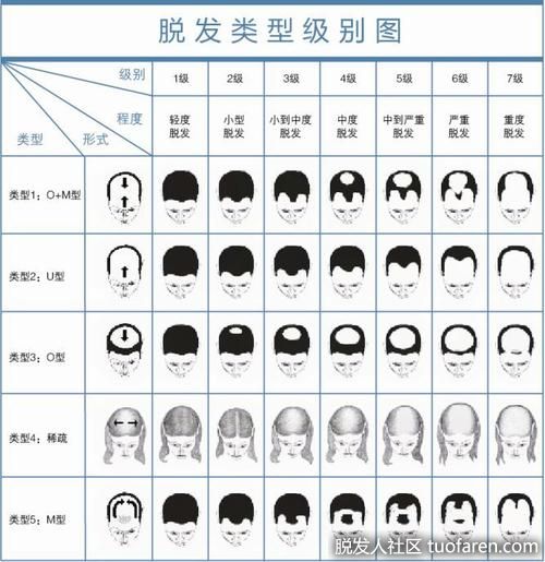 脱髮類型、脱髮等級對照圖1