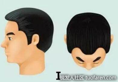 1級為髮際線完全正常或輕度後移