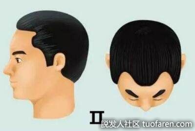 2級表現為額顳部發際呈三角形後移，距外耳道連線處達2釐米