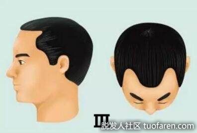 3級是額顳部發際後退更明顯，距外耳道連線正常髮際超過2釐米；3級變異型常見於老年人，頭頂全禿伴額顳部髮際線後退，程度不超過3級