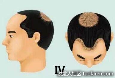 4級是頭頂部脱髮伴額中部發際後退，一束濃密的頭髮將這兩個區域分開