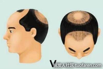 5級前額部更大瀰漫性脱髮或禿頂，隔開這兩個區域的髮帶縮窄、毛髮密度減低