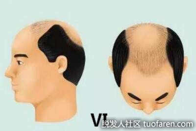 6級是馬蹄形脱髮，側面和後面脱髮區增加