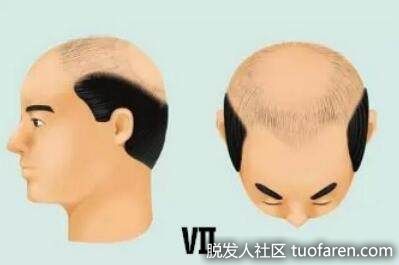 7級是男性雄激素性禿髮的嚴重形式，除馬蹄形脱髮外，耳周和枕部出現脱髮