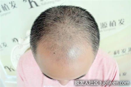 植髮前，頭頂部