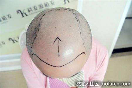 植髮前設計區域，頭頂部