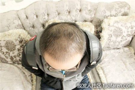 植髮後恢復期，頭頂部