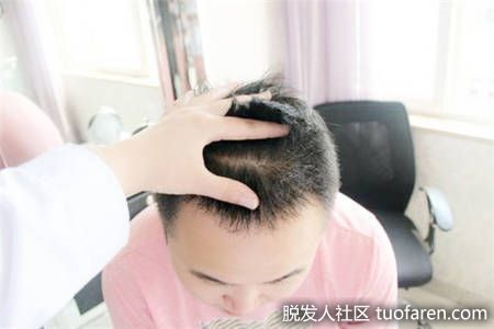 植髮後恢復期，頭頂部