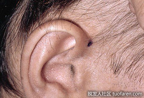 男性休止期脱髮圖 兩側區域