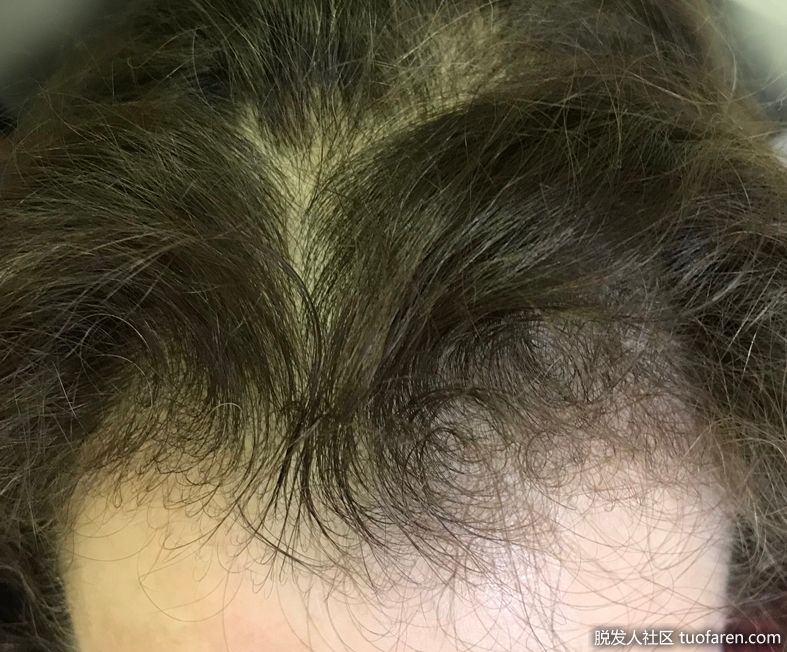 女性休止期脱髮圖 頭頂區域