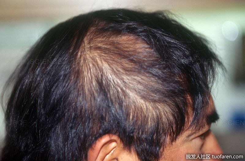男性休止期脱髮圖 兩側區域