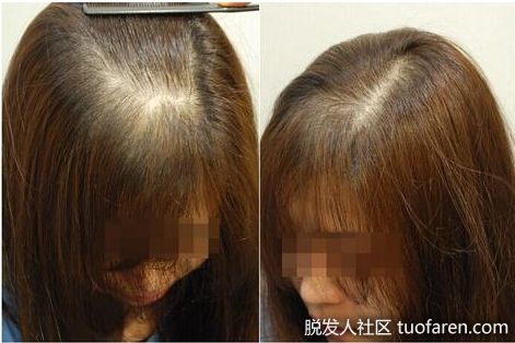 女性休止期脱髮圖 兩側區域