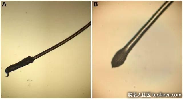 休止期脱髮髮根圖
