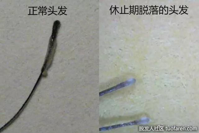 休止期脱髮髮根圖