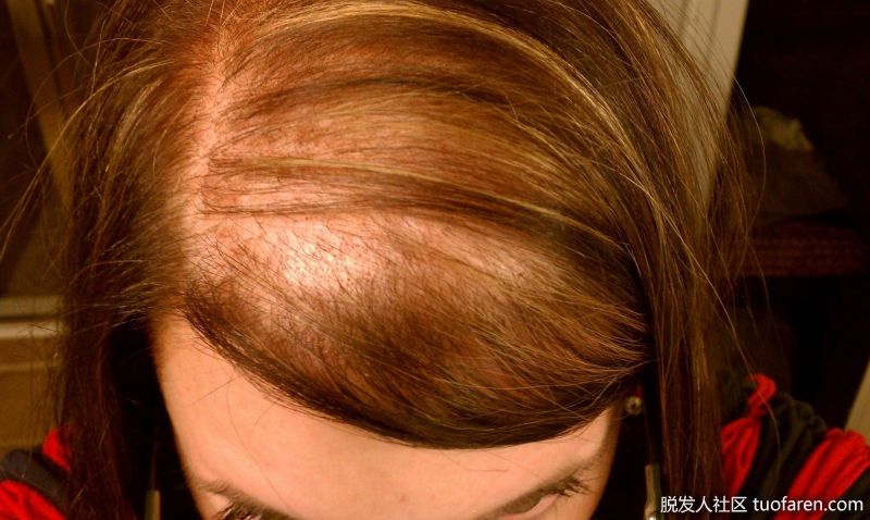 女性瀰漫性脱髮圖2
