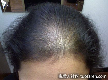 女性瀰漫性脱髮圖4