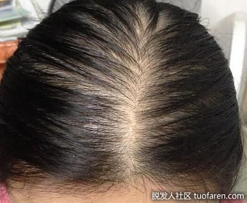 女性瀰漫性脱髮圖5