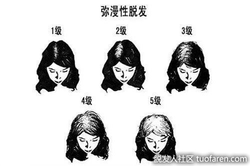 女性瀰漫性脱髮圖6