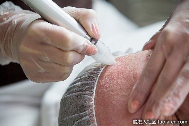 擦皮法：在這個過程中，醫生會用快速旋轉的刷子磨掉你有斑點的皮膚，這樣新的皮膚就可以代替它了。你可能要做不止一次。這個過程會導致紅腫、結痂和腫脹。你的皮膚也需要很長時間才能癒合，看起來恢復正常。