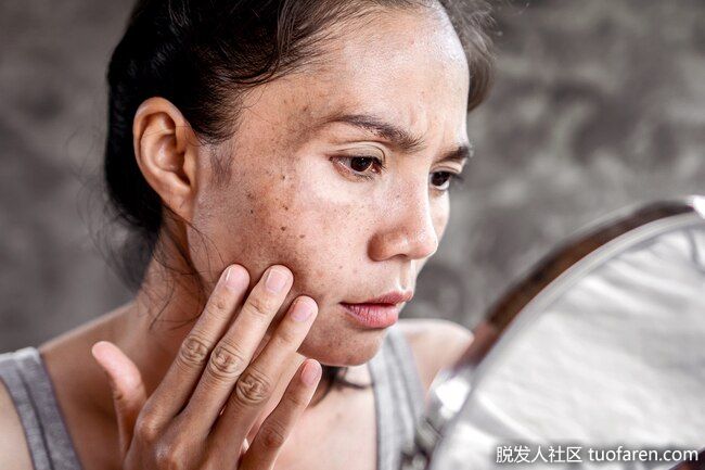 可能會減少暗斑：基於維生素c的護膚品可能會使你的皮膚比其他皮膚暗一些，這被稱為色素沉着。在一項研究中，將維生素C塗抹在皮膚上16周後，臉上暗斑就會明顯減少。但專家表示，還需要更多的研究來證實維生素C面霜的效果如何。
