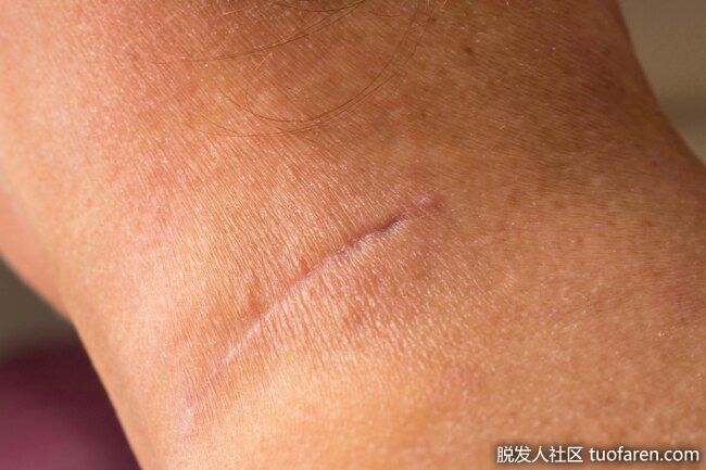 減少疤痕：在一項研究中，維生素C凝膠應用在皮膚上可以使手術疤痕不那麼明顯。在這項包括80人的實驗中，他們中的一半人在拆線後的6個月裏每天在傷口上塗抹維他命注入的硅膠。之後，他們的傷疤比那些沒有使用過該產品的人更不明顯。