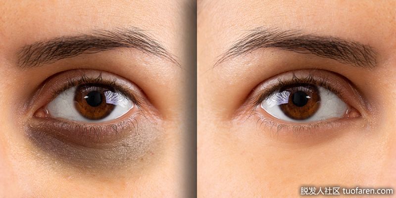 減少黑眼圈。喝完甘菊茶後，不要扔掉那些袋子，你可以把它們冷藏起來。把冰茶包放在眼睛上(尤其是在做了按摩之後)，這樣可以顯著地減輕眼部的浮腫。你會發現你的眼睛在看和感覺上有了迅速的變化。