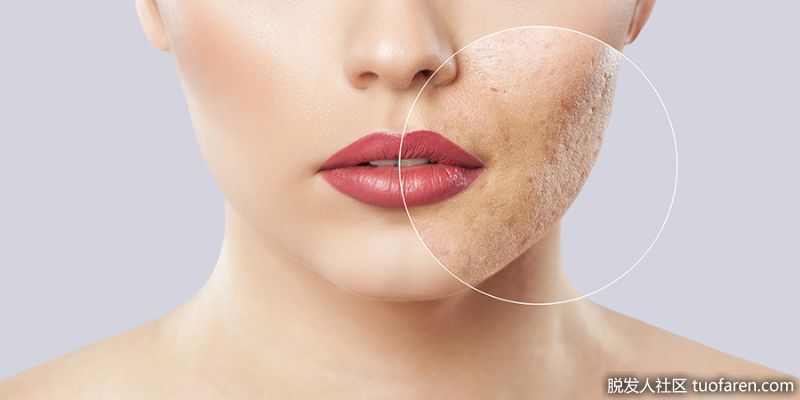 減少痤瘡。洋甘菊茶可以祛痘。甘菊茶不僅能讓你煥發光彩，還能幫助你結束與頻繁痤瘡的戰爭，幫助淡化斑點，消除痤瘡疤痕，如果局部使用的話，還能對抗痘痘。這要歸功於它的消炎和殺菌特性。