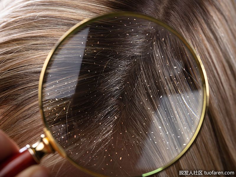 減少頭皮屑。喝一杯甘菊茶。是的，我們是認真的。甘菊茶有助於消除和預防頭皮屑，舒緩頭皮刺激，促進健康。洗完頭髮後，你必須用它作最後的漂洗。就這麼簡單!