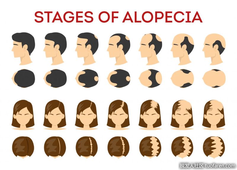 男性女性脱髮階段圖