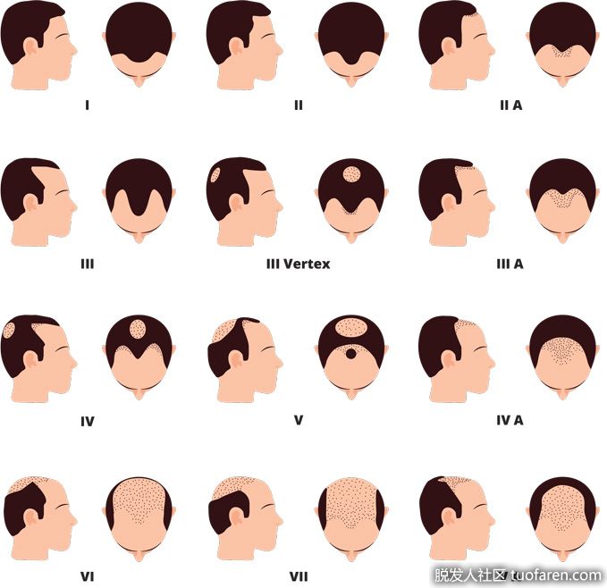 男性脱髮等級圖