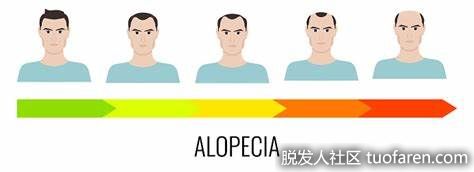 男性脱髮階段