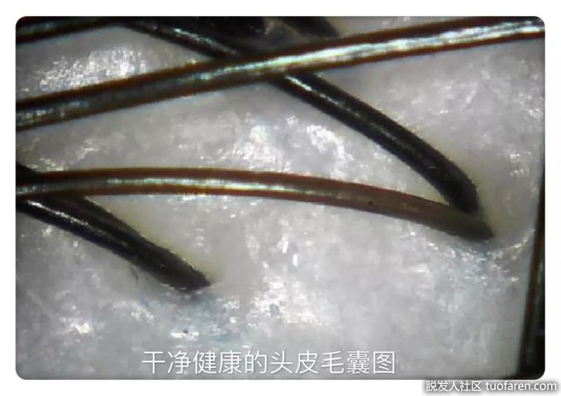 乾淨健康的頭皮毛囊圖