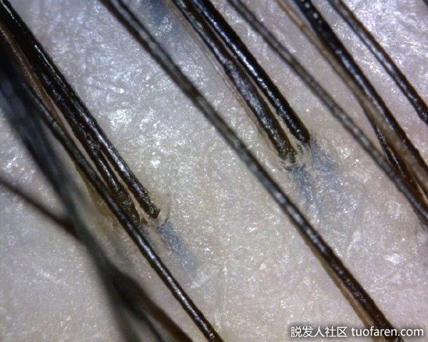 正常的頭皮毛囊圖