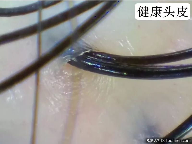 健康頭皮毛囊圖