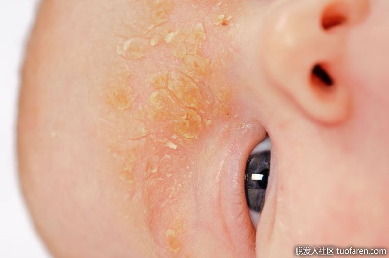兒童脂溢性皮炎的圖片1