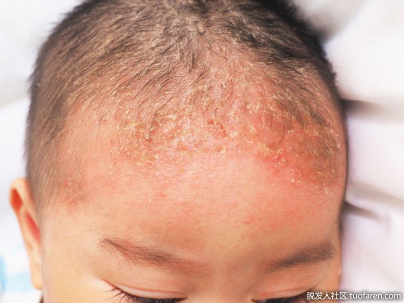 兒童脂溢性皮炎的圖片3