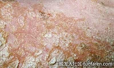 真菌皮炎圖片1