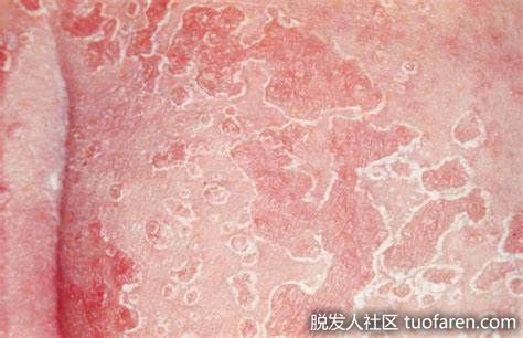 真菌皮炎圖片2