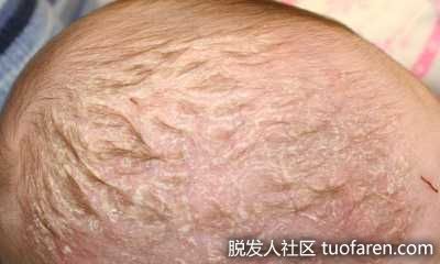 嬰兒脂溢性皮炎圖片1